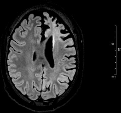 Functional Cerebral Specialization and Decision Making in the Iowa Gambling Task: A Single-Case Study of Left-Hemispheric Atrophy and Hemispherotomy